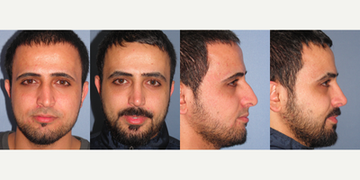 Rhinoplasty before and after photo