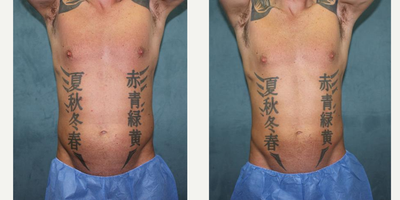CoolSculpting before and after photo