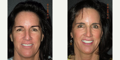 Eyelid Surgery before and after photo