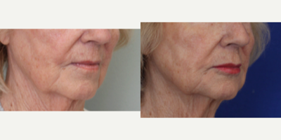 Dermal Fillers before and after photo