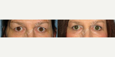 Eyelid Surgery before and after photo