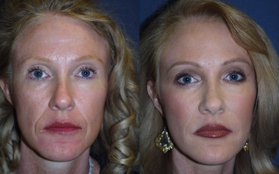 Facelift before and after photo