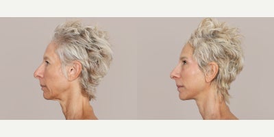 Facelift before and after photo