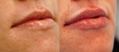 Lip Fillers before and after photo