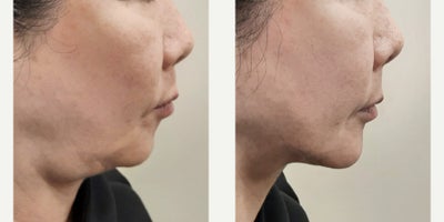 Radiesse before and after photo