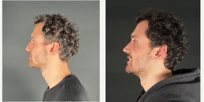 Revision Rhinoplasty before and after photo