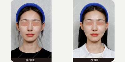 Skin Rejuvenation before and after photo