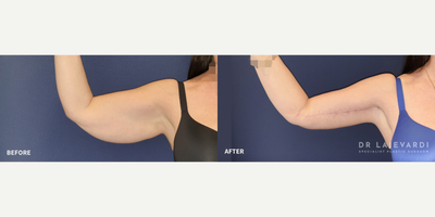Arm Lift before and after photo