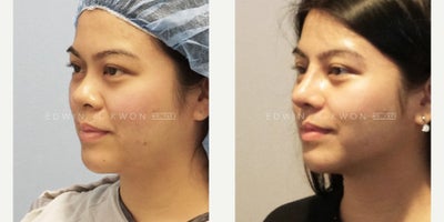 Asian Rhinoplasty before and after photo