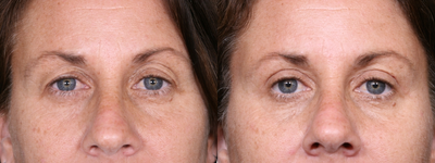 Eyelid Surgery before and after photo