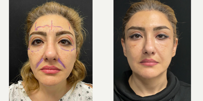 Facelift before and after photo