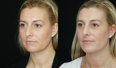 Rhinoplasty before and after photo