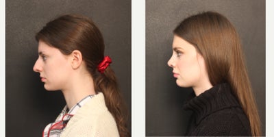 Rhinoplasty before and after photo