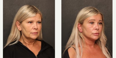 Brow Lift before and after photo