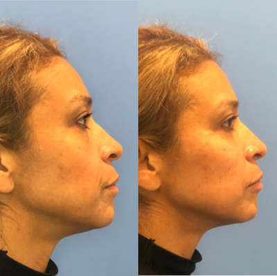 Dermal Fillers before and after photo
