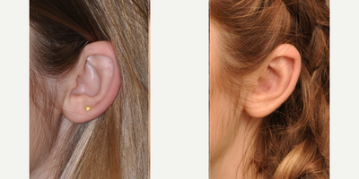 Ear Surgery before and after photo