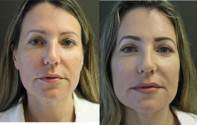 Eyelid Surgery before and after photo