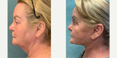 Facelift before and after photo