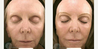 Laser Resurfacing before and after photo