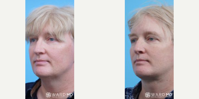 Facelift before and after photo