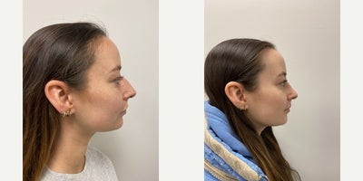 Rhinoplasty before and after photo