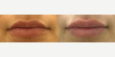 Volbella before and after photo