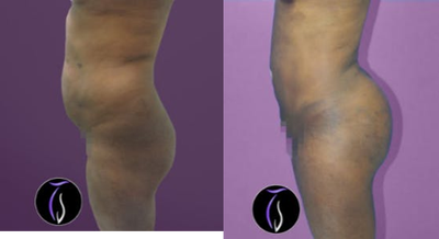 Brazilian Butt Lift before and after photo