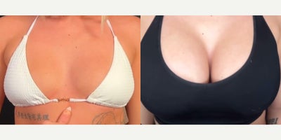 Breast Implants before and after photo