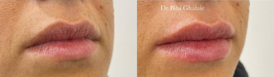 Lip Fillers before and after photo