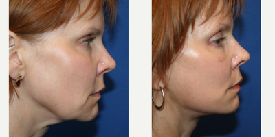 Facelift before and after photo