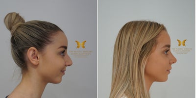 Rhinoplasty before and after photo