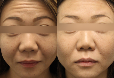 Botox before and after photo