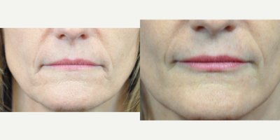 Botox before and after photo