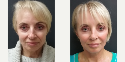 Botox before and after photo