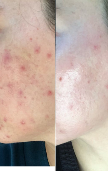 Chemical Peel before and after photo
