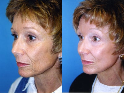 CO2 Laser before and after photo