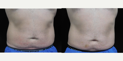 CoolSculpting before and after photo