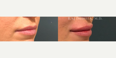 Dermal Fillers before and after photo