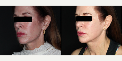 before and after image