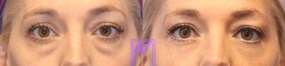 Eyelid Surgery before and after photo