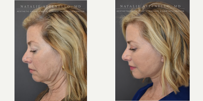 Facelift before and after photo