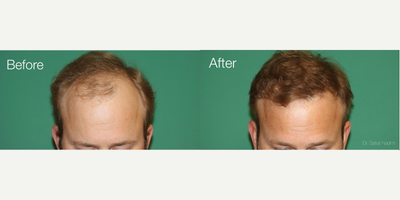 FUE Hair Transplant before and after photo