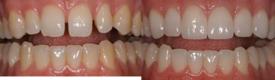 Porcelain Veneers before and after photo