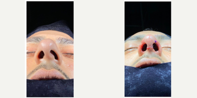 Alarplasty before and after photo