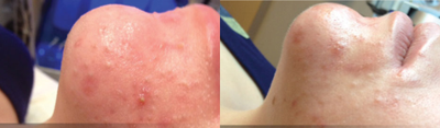 Facial before and after photo