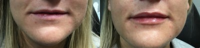 Lip Fillers before and after photo