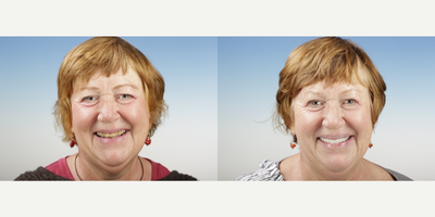 Porcelain Veneers before and after photo