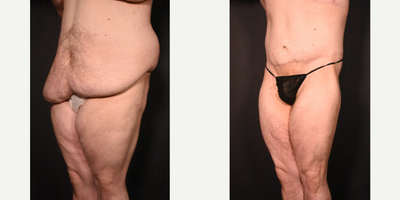 Body Lift before and after photo