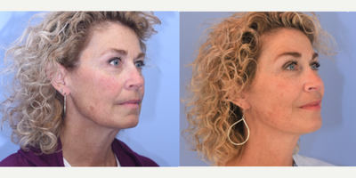Eyelid Surgery before and after photo