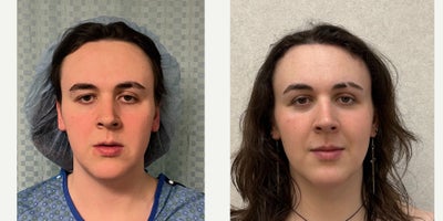 Forehead Reduction before and after photo